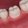 Premium Crown Preparation Set by prof. Dr Zavadka - Image 9